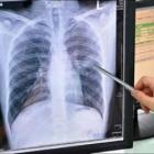 В Перник има два нови случая на туберколоза 02_1424251490
