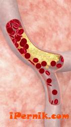 Наночастици прочистват артериите от холестерол 02_1424523109