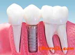 Използването на импланти е едно от най-големите постижения в стоматологията 04_1429535790